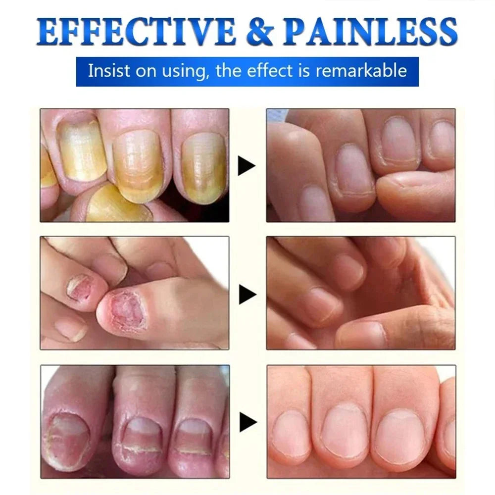 Fungal Nail Laser Device Toe Nail Fungus Removal Fast Repair Onychomycosis Toenail Fingernail Foot Care Cure Ingrown