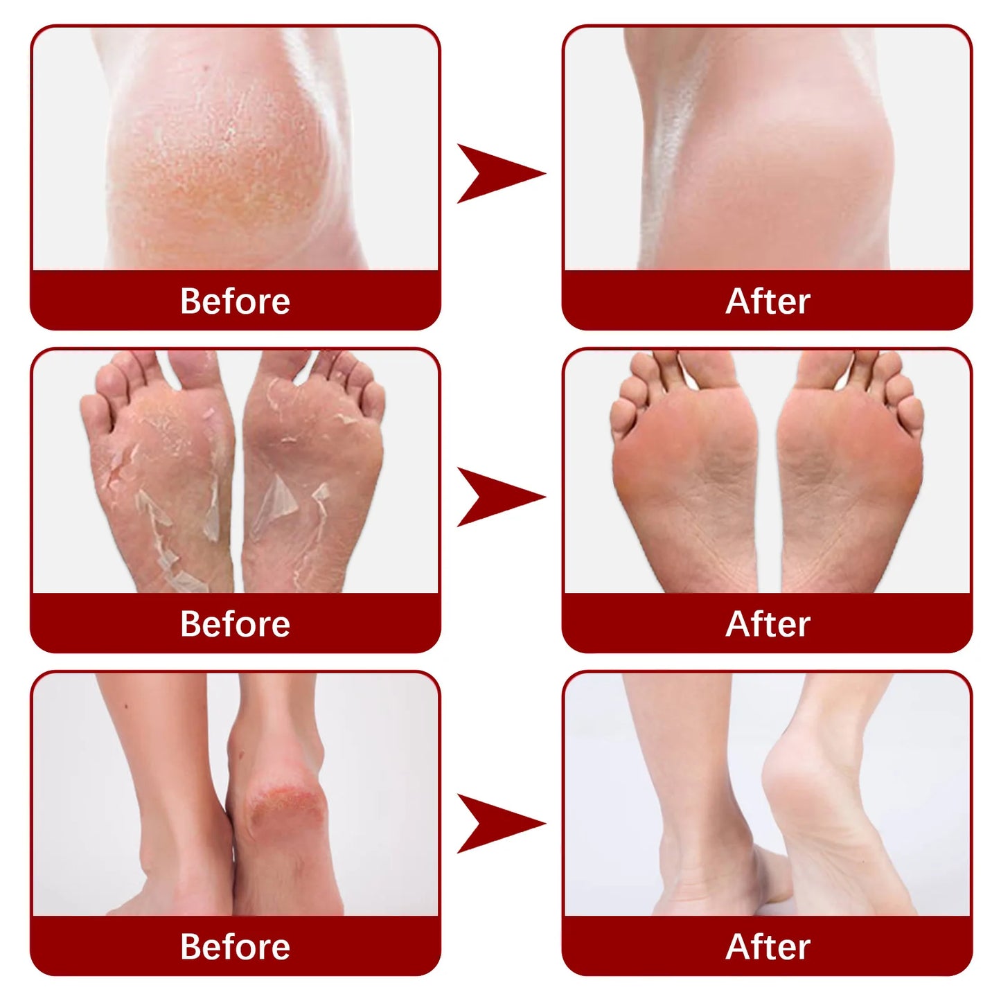 5/1Pair Feet Exfoliating Foot Masks Pedicure Socks Exfoliation Scrub for Feet Mask Pedicure Stone Foot Peeling Mask For Foot Spa