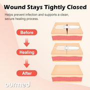 Wound Closure Strips(0.6"x 3.1" - 4 Pcs), Butterfly Bandages for Wound Care, Steri Emergency Laceration Closures Without Stitches for Outdoors Use.