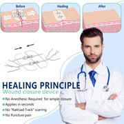 Zip Sutures Butterfly Bandaids, 4 Sets Emergency Wound Closures Device - Surgical Quality Laceration Repair Kit Without Stitches, Quick Clot Zip Sutures Laceration Kit