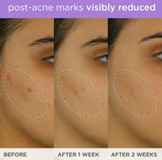 The Brightening Serum | Vitamin C Treatment for Brighter, Firmer Skin – Targets Hyperpigmentation & Fades Post-Acne Marks, 30 ml / 1.0 fl. oz.