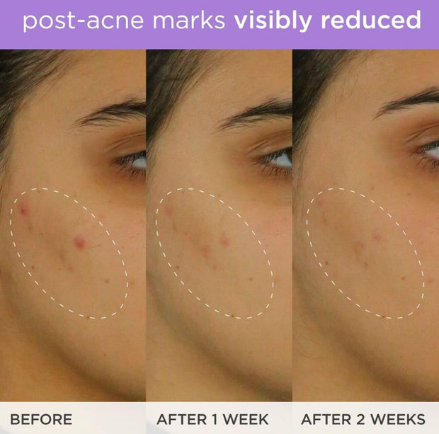 The Brightening Serum | Vitamin C Treatment for Brighter, Firmer Skin – Targets Hyperpigmentation & Fades Post-Acne Marks, 30 ml / 1.0 fl. oz.