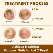 Nail Growth Serum, Ginger Nail Serum, Nails Repair Cuticles Oil, Ginger Nail Oil for Strengthen & Promote Nails Growth, Natural Plant Formula