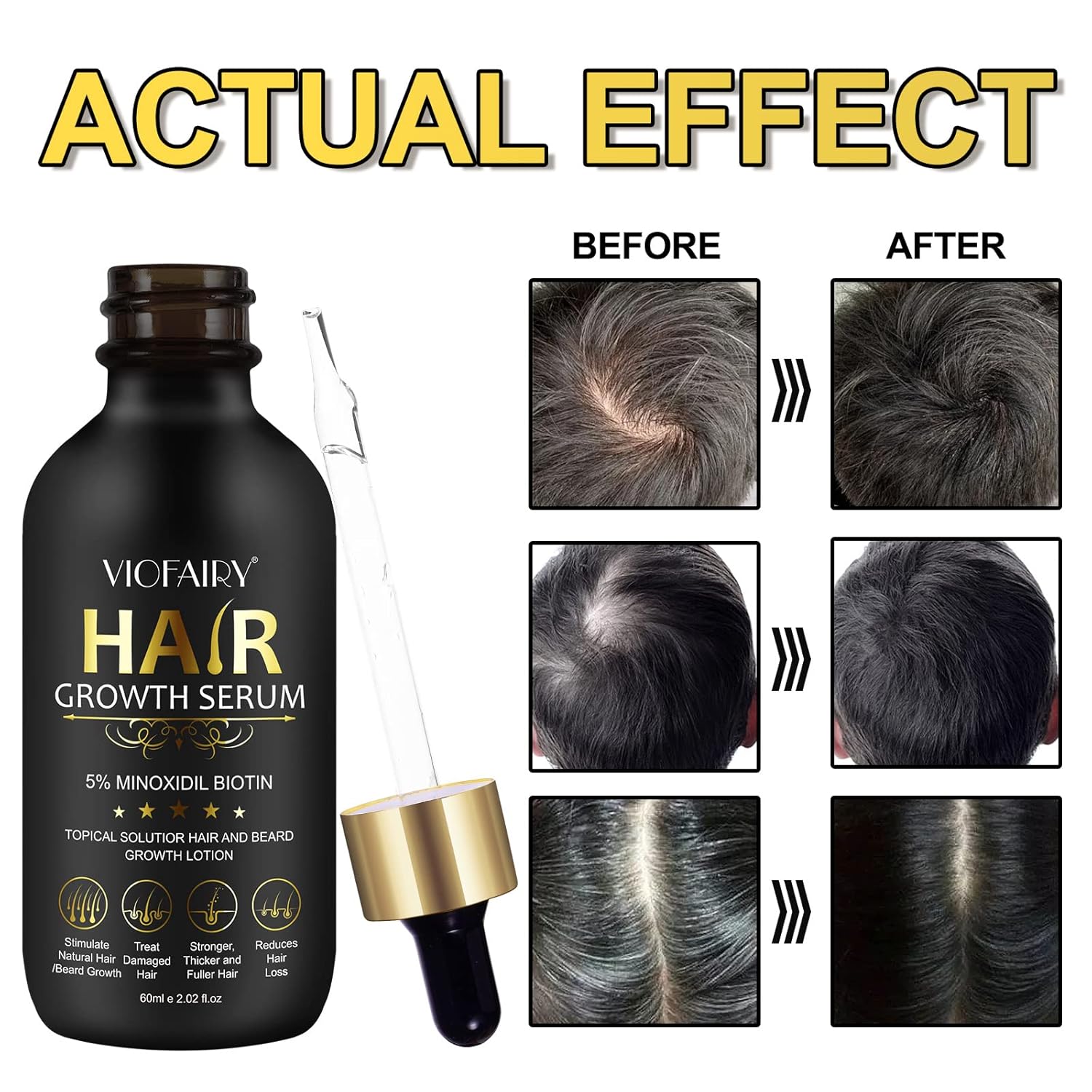 5% Minoxidil for Men and Women - Biotin Hair And Beard Growth Serum & 5% Minoxidil Treatment for Stronger Thicker Longer – Natural Growth Thickening Treatment - Stop Thinning & Hair Loss-1Month supply