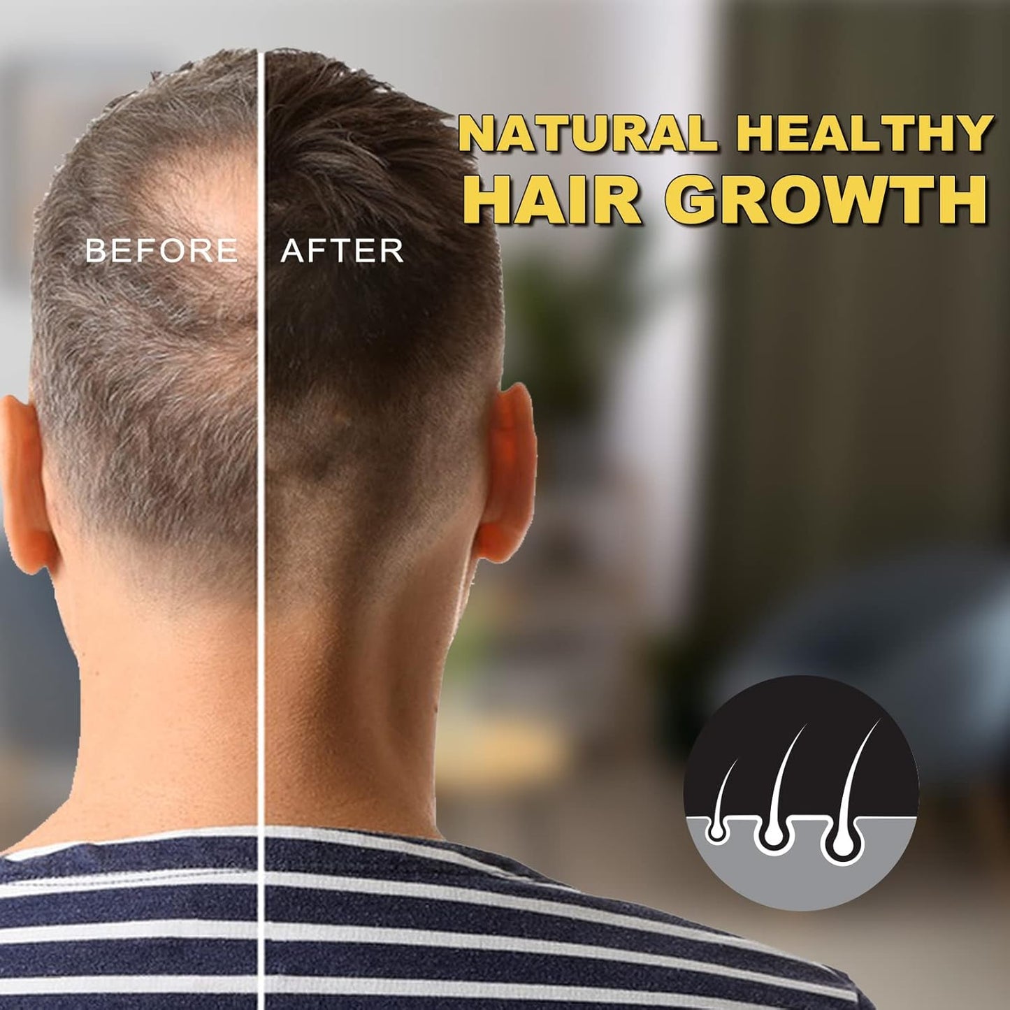 5% Minoxidil for Men and Women - Biotin Hair And Beard Growth Serum & 5% Minoxidil Treatment for Stronger Thicker Longer – Natural Growth Thickening Treatment - Stop Thinning & Hair Loss-1Month supply