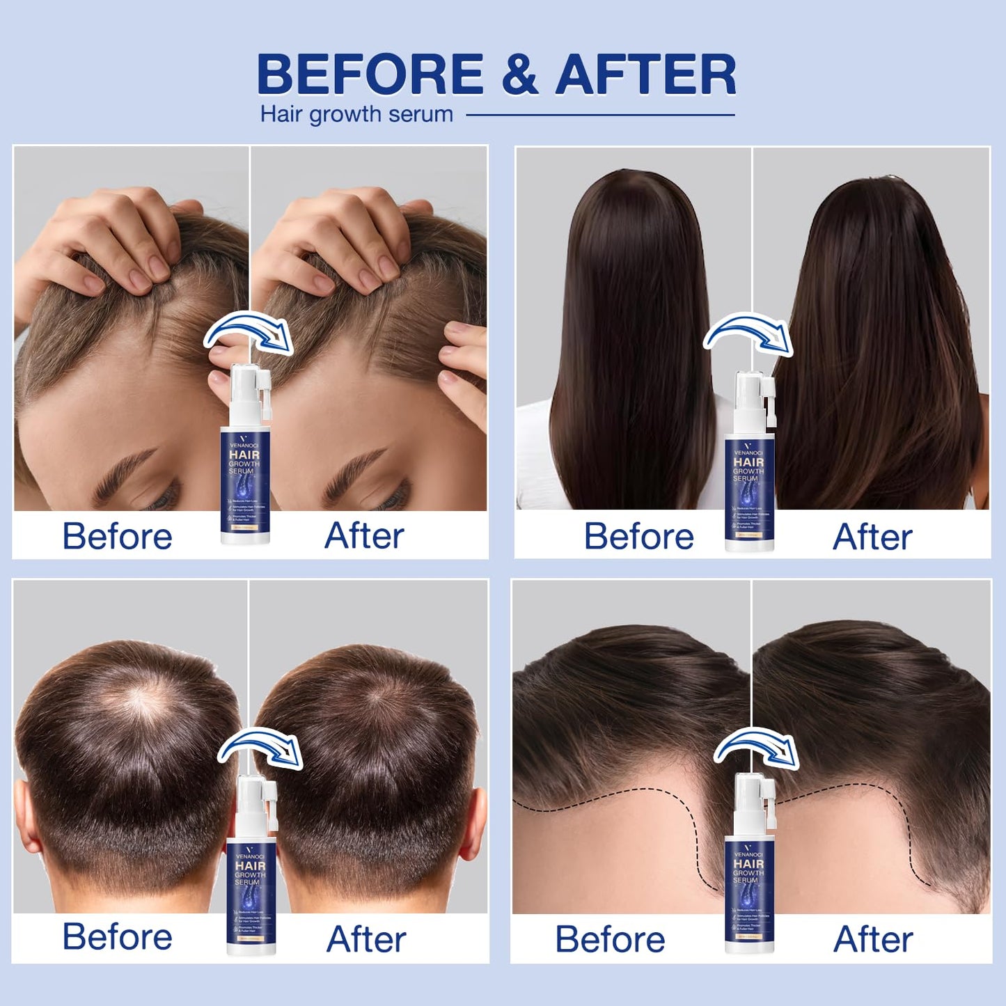 VENANOCI Hair Growth Oil Spray: with Rosemary, Biotin, Batana Oil & Rice Water – Natural Anti-Hair Loss Treatment for Thinning Hair – Promotes Thicker, Fuller Hair for Women & Men – All Hair Types