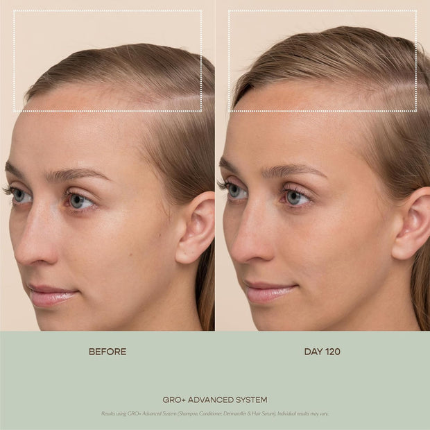 VEGAMOUR GRO+ Advanced Hair Serum for Hair Density, Reduces Shedding and Promotes a Healthy Scalp, Helps with Severe Signs of Thinning, Made Without Fragrance, Vegan, Cruelty-Free