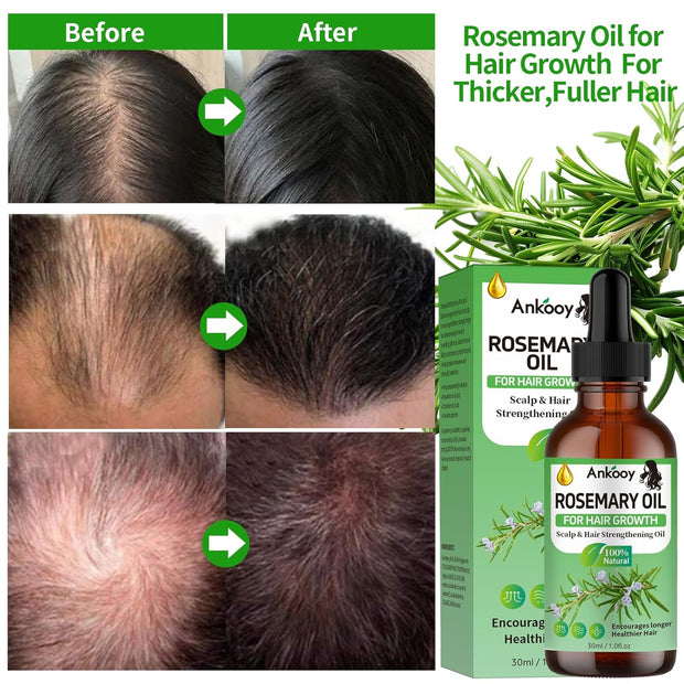 3 Pack Rosemary Oil for Hair Growth,Rosemary Hair Growth Oil,Hair Strengthening Serum for Dry Damaged Hair,Hair Loss Treatment & Thickens Hair,Scalp Care Promotes Hair Thickness for Men Women