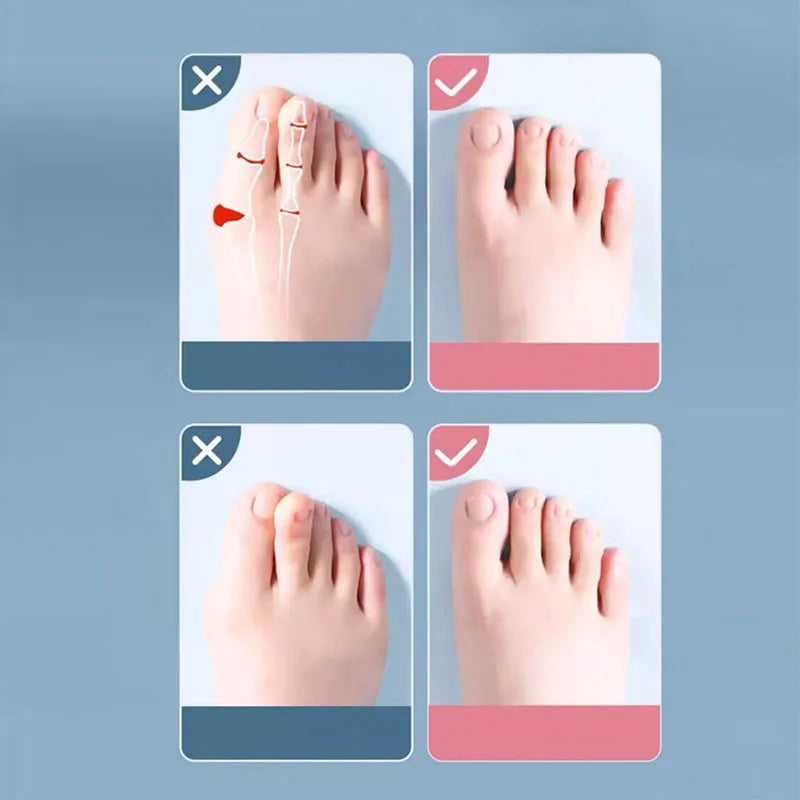 2Pc Silicone Toe Separator Fingers Feet Toe Spreader Hallux Valgus Bunion Corrector Toe Straightener Corrector Finger Separators