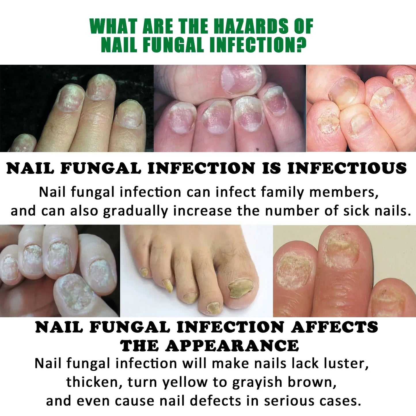 Fungal Nail Laser Device Toe Nail Fungus Removal Fast Repair Onychomycosis Toenail Fingernail Foot Care Cure Ingrown